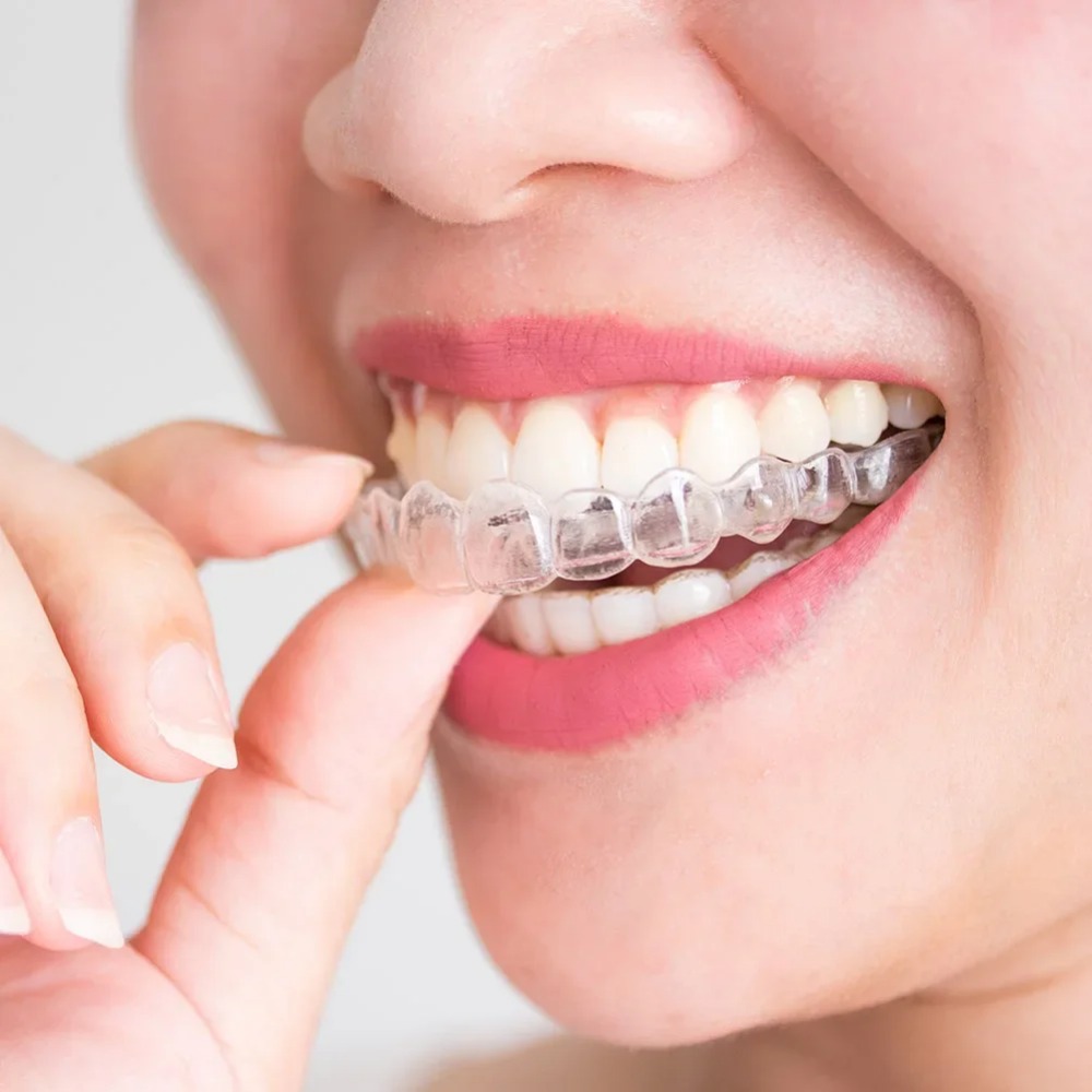 1-4 Pezzi Paradenti Anti-Russa - Teeth Whitening Mouth Guard recensione e prezzo