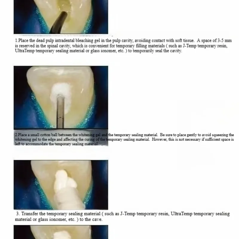 Materiali per il restauro oral - Teeth Whitening Effects recensione e prezzo