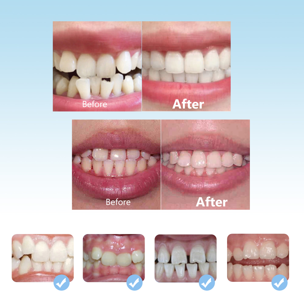 Set di apparecchi ortodontici  - Teeth Whitening Mouth Guard recensione e prezzo