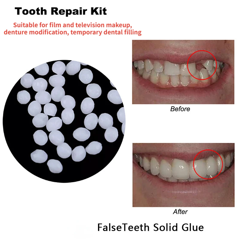 Colla per riparazione dei dent - Teeth Whitening At Home recensione e prezzo