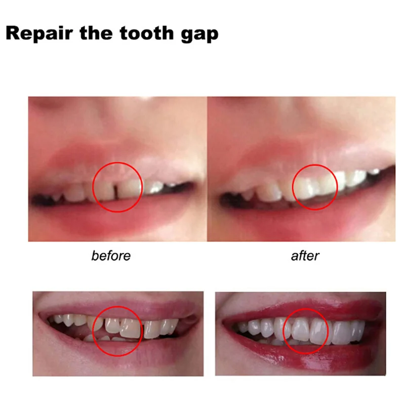 Colla per riparazione dei dent - Teeth Whitening At Home recensione e prezzo