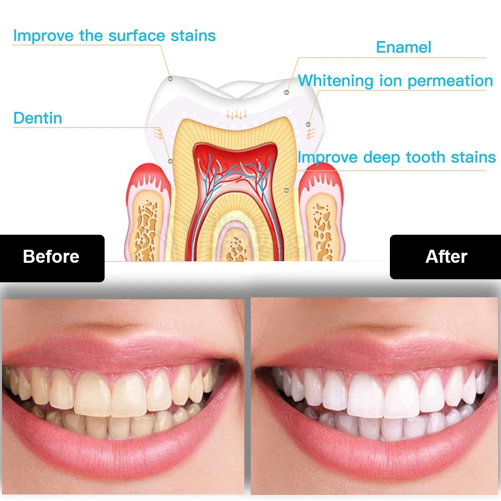 Kit per sbiancamento dei denti - Teeth Whitening Levels recensione e prezzo