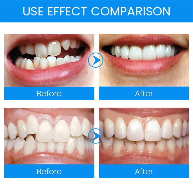3 fasi Apparecchi ortodontici  - Teeth Whitening Mouth Guard recensione e prezzo