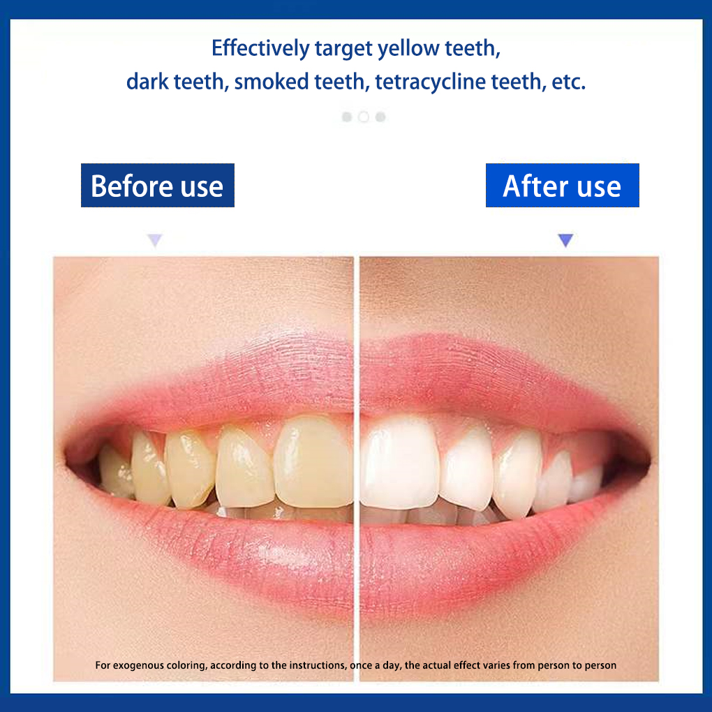 70/140 paia 5D strisce sbianca - Teeth Whitening Effects recensione e prezzo